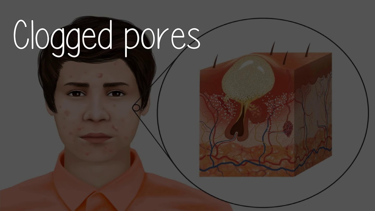 Can The Bed Sheets I Use Be The Cause Of My Acne?