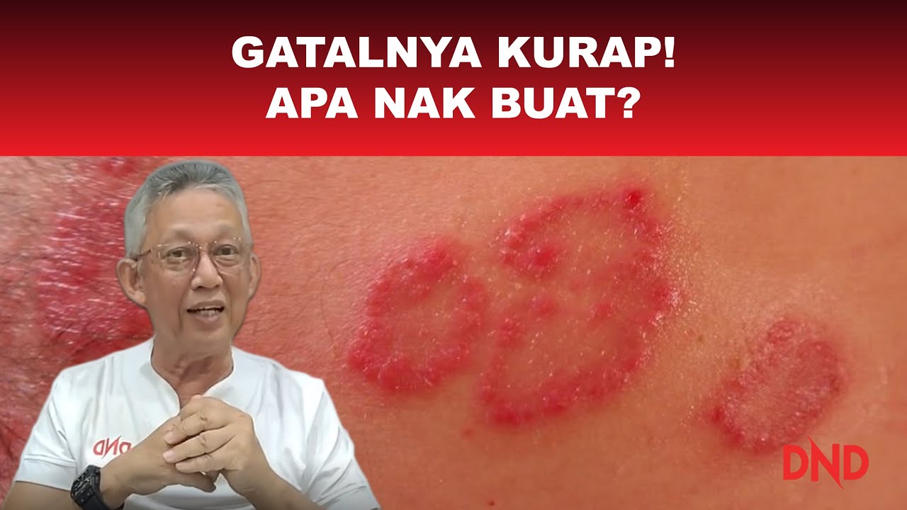 Ada Sebahagian Anggota Badan yang Gatal dan Berulang-ulang Jadinya! KURAP Ke? Apa Nak Buat?