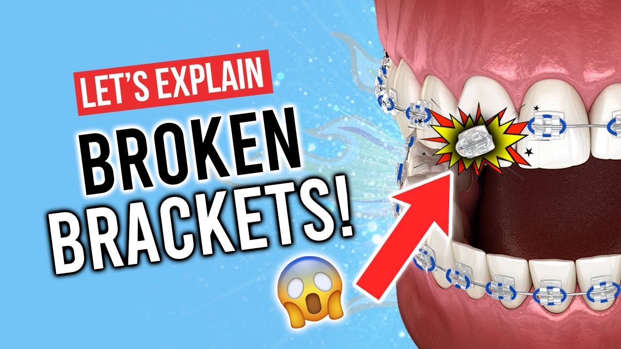 Do BROKEN BRACKETS Delay BRACES Treatment?!