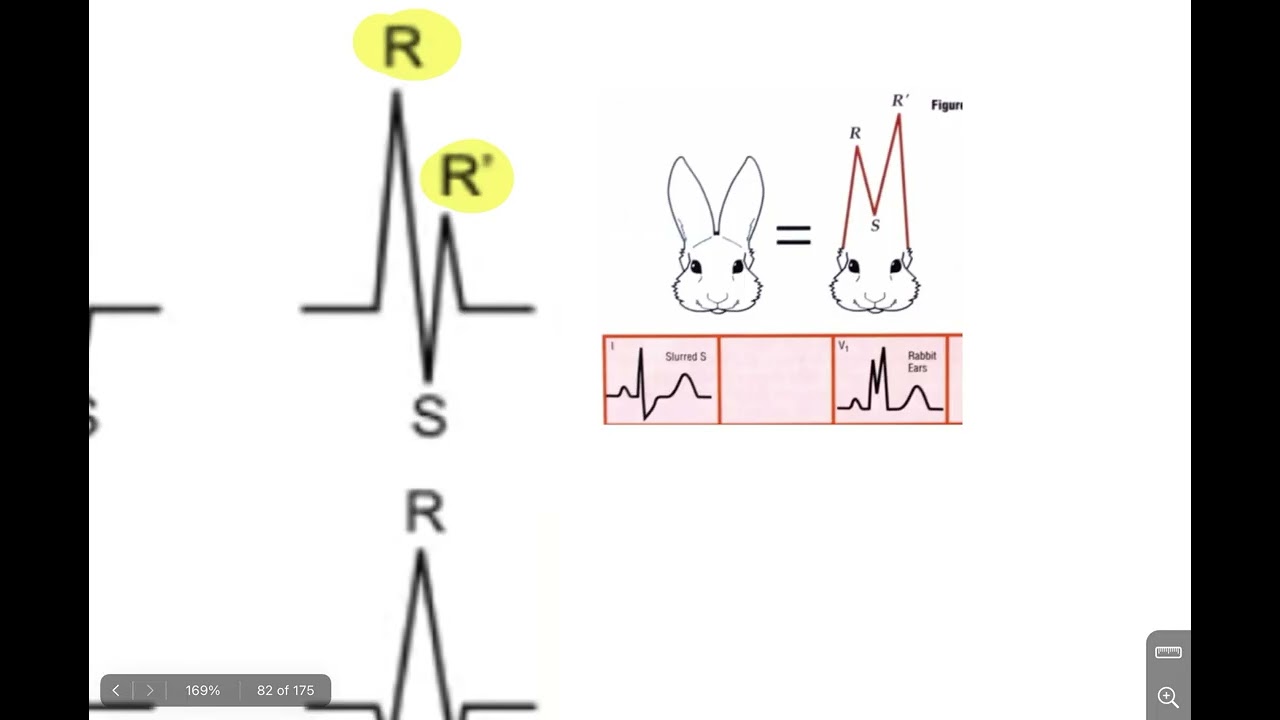 ECG 7