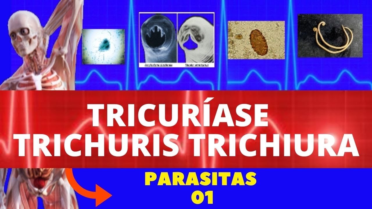 TRICURÍASE - TRICHURIS TRICHIURA (VERMINOSE) - PARASITOLOGIA  | INFECTOLOGIA