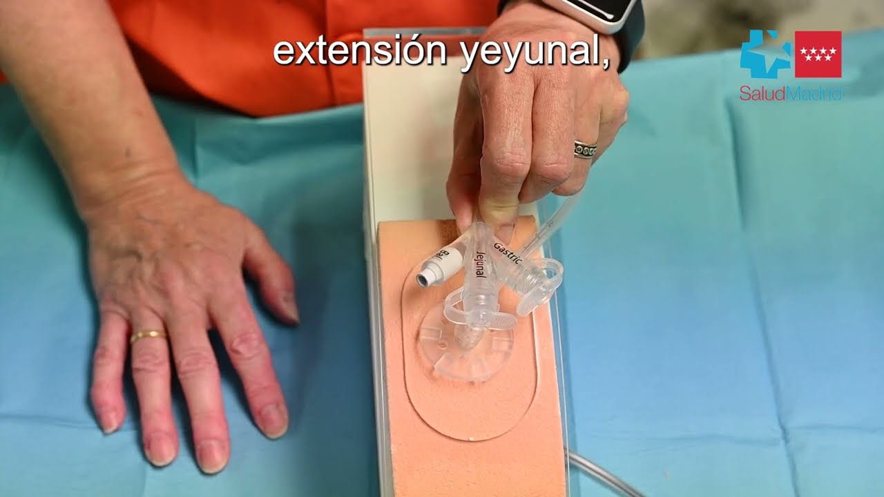 Hospital Gregorio Marañón - Gastrostomía Endoscópica Percutánea. Sonda con extensión yeyunal