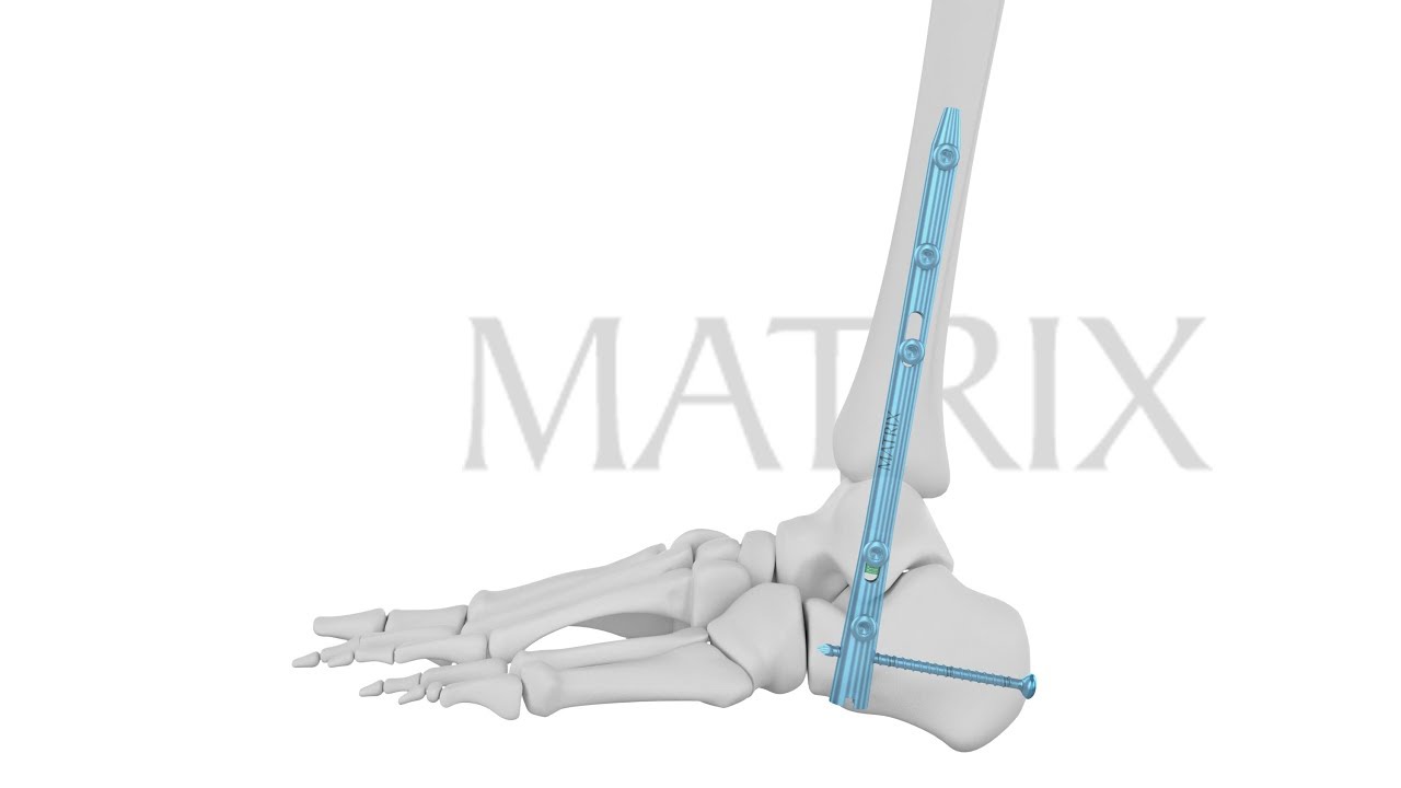 Matrix Meditec TTC Viva Ankle Arthrodesis Nail Surgical Technique