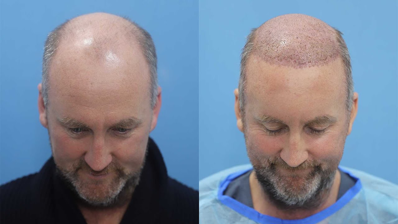 Hair Transplant Results in Grade 7  | Irish Guy Gets 7000+ Grafts From Eugenix By- Expert Surgeons