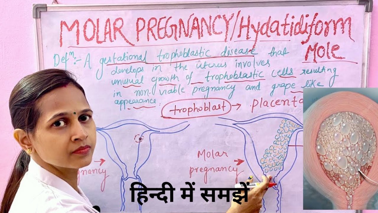 Molar Pregnancy/ Hydatidiform Mole/Important for all nursing exams/असमान्य गर्भावस्था