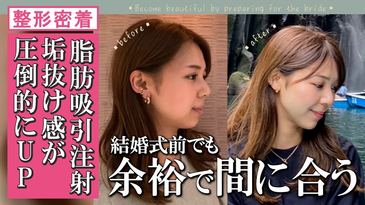 【恐ろしくあか抜ける脂肪吸引注射】糸リフトと同時施術で生涯NO.1フェイスになりました【フェイスライン上げて結婚式♥】湘南美容クリニック