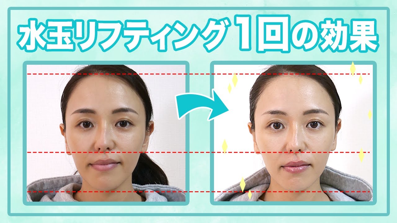 気になる“たるみ”にアプローチ！肌質に合わせた施術ができる話題の「水玉リフティング」｜テクスパクイーン（TechSpa Queen）
