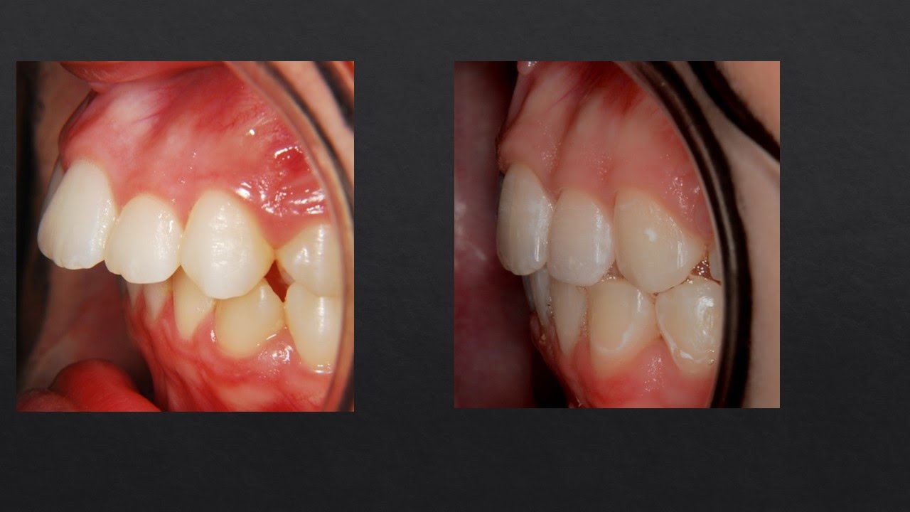 8mm Overjet Correction,  Orthodontics.