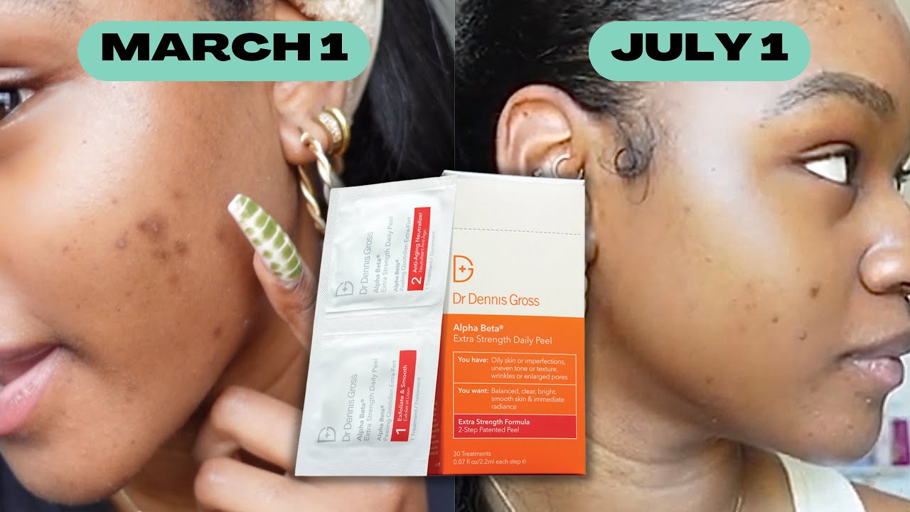 Monthly SKIN CHECK | Dr Dennis Gross Daily Peel for 2 WEEKS STRAIGHT | June-July Progress & Routine