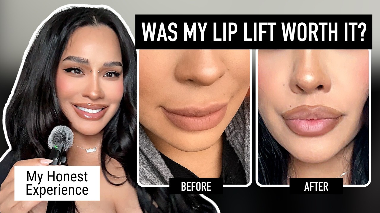 Was My Lip Lift Worth It? My Honest Experience