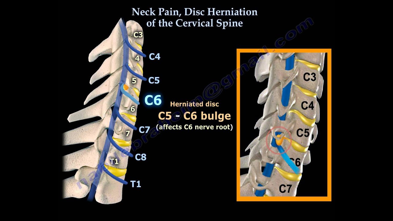 Neck Pain, Disc Herniation Of The Cervical Spine - Everything You Need To Know - Dr. Nabil Ebraheim