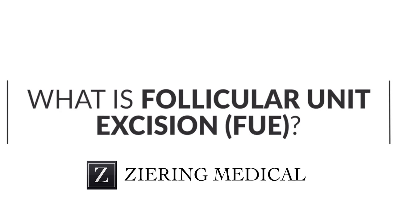 Follicular Unit Excision (FUE) | Ziering Medical | Hair Transplant FAQs |