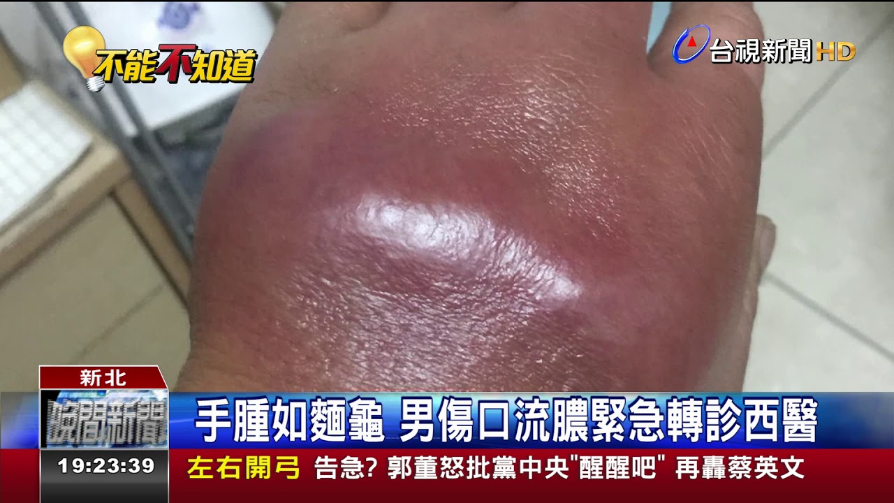 搬重物手腫男針灸惡化蜂窩性組織炎