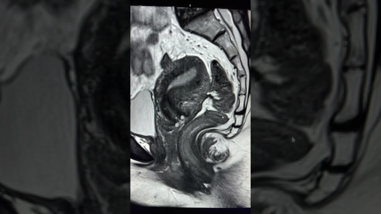 Classic Deep pelvic endometriosis #endometriosis #questionmarksign #deeppelvicendimetriosis