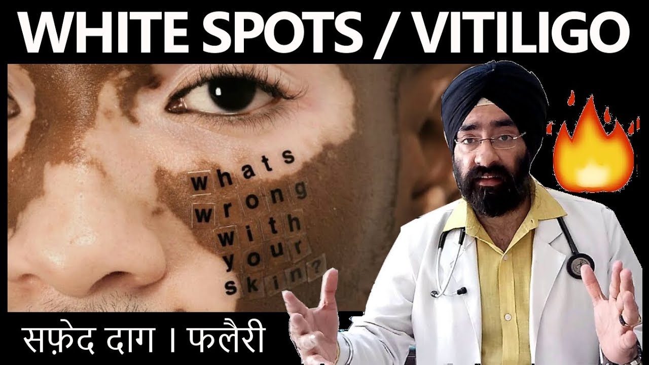 How to Cure सफ़ेद दाग, White Spots, Vitiligo, Leucoderma, Hypopigmentation (HINDI) Dr.Education