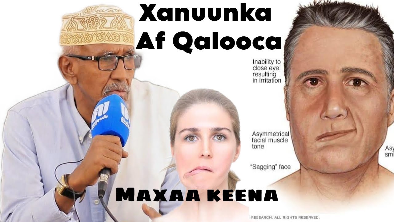 FARIIN CAAFIMAAD: Xanuunka af qalooca waxa sababa iyo Habka loo daaweeyo || Dr Bashiir Cali Biixi