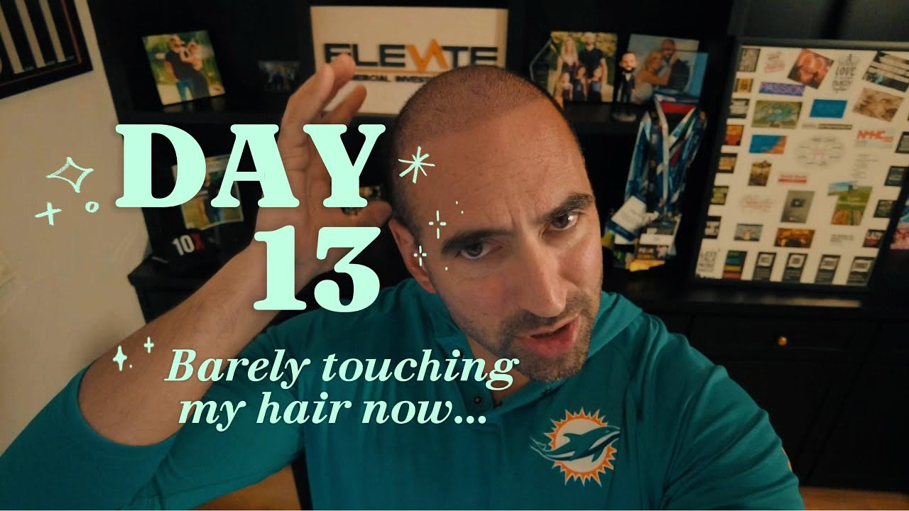 👉 I hit my head twice after my hair transplant | Day 13 Update
