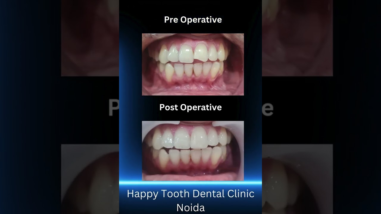Direct Composite Veneers - Happy Tooth Dental Clinic Noida