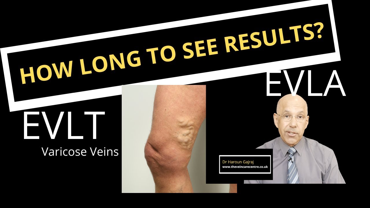 Why can I still see varicose veins after Endovenous Laser Ablation? | How long to see result?