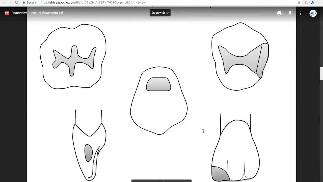 Pre-Dental Academy - gaining dental school acceptance - Restorative 1- Class I and V lecture demo