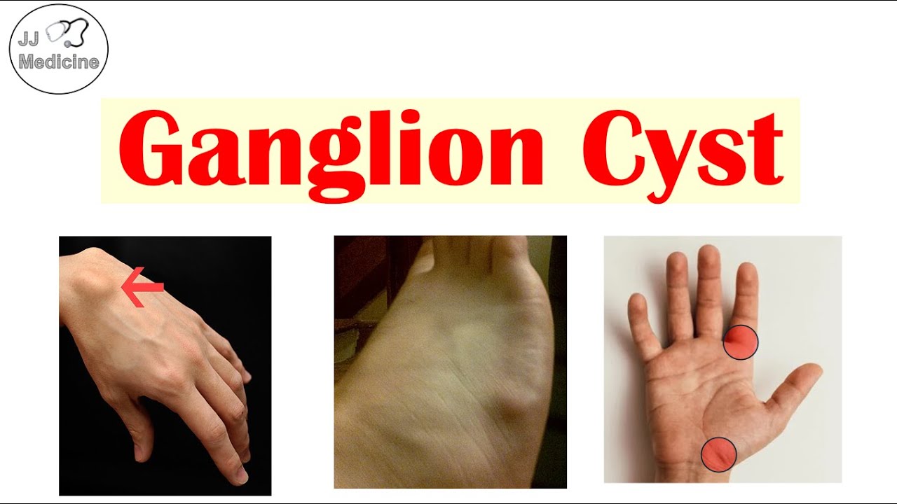 Ganglion Cyst (Lump On Hand) | What Causes Them, Symptoms, Diagnosis, Treatment