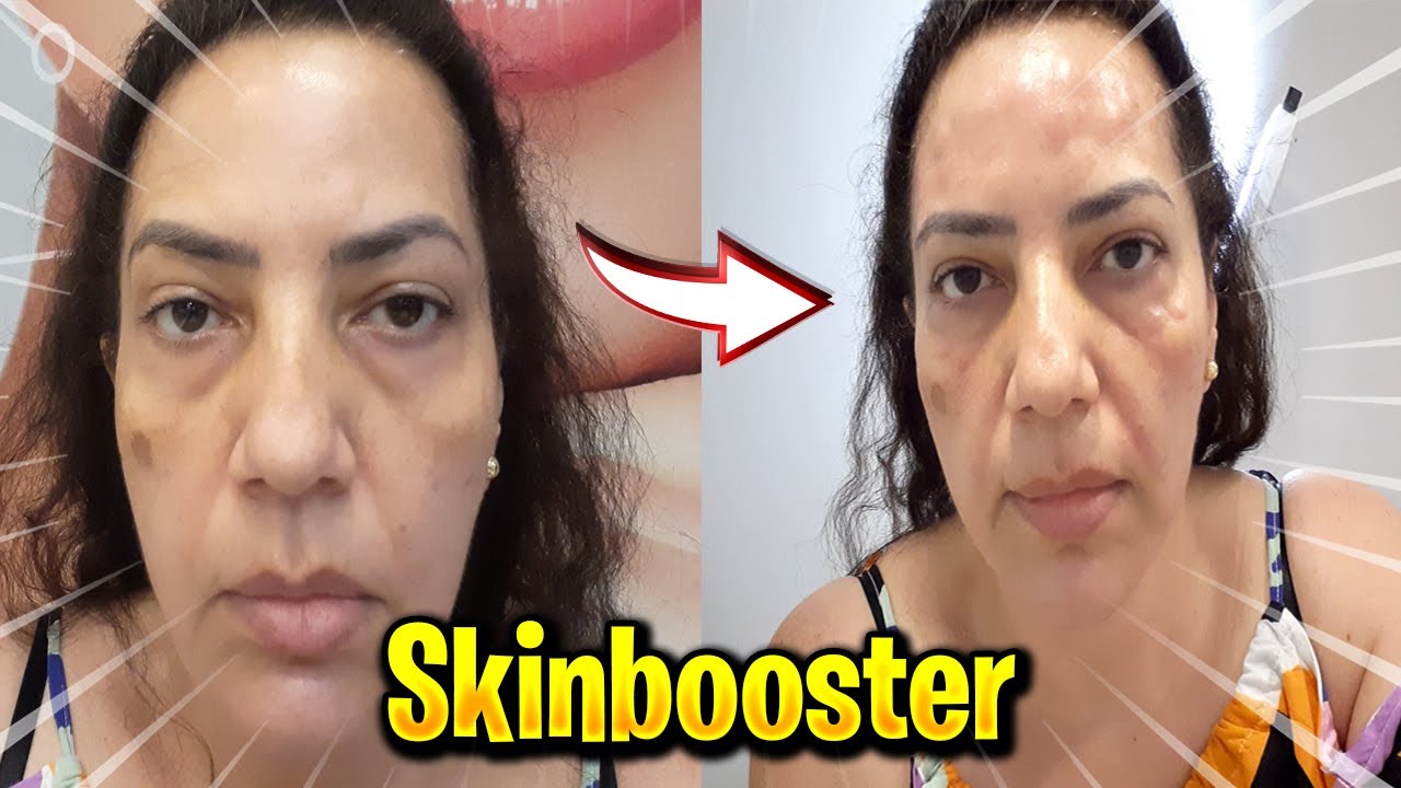 MINHA EXPERIÊNCIA COM O SKINBOOSTER