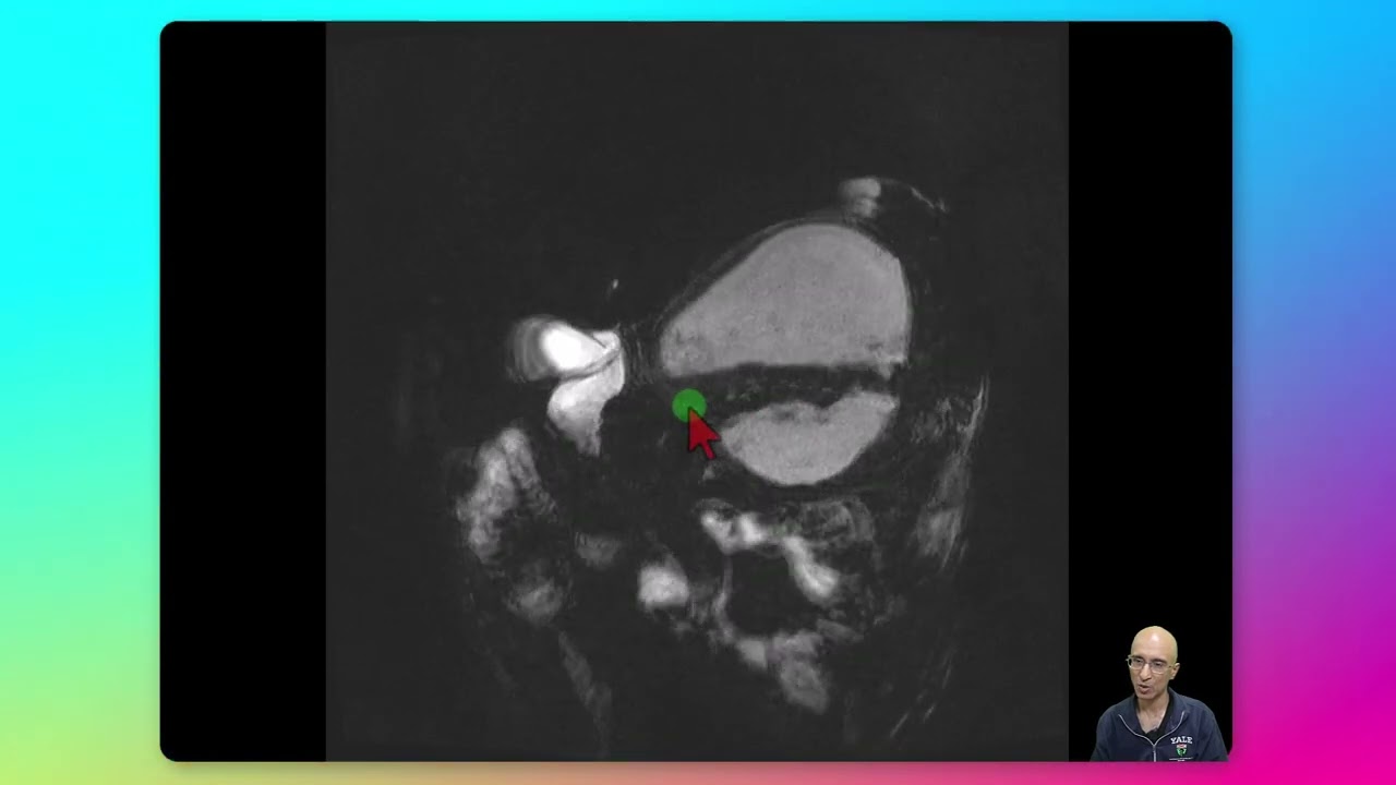 Pancreatic pseudocyst folling scoliosis surgery