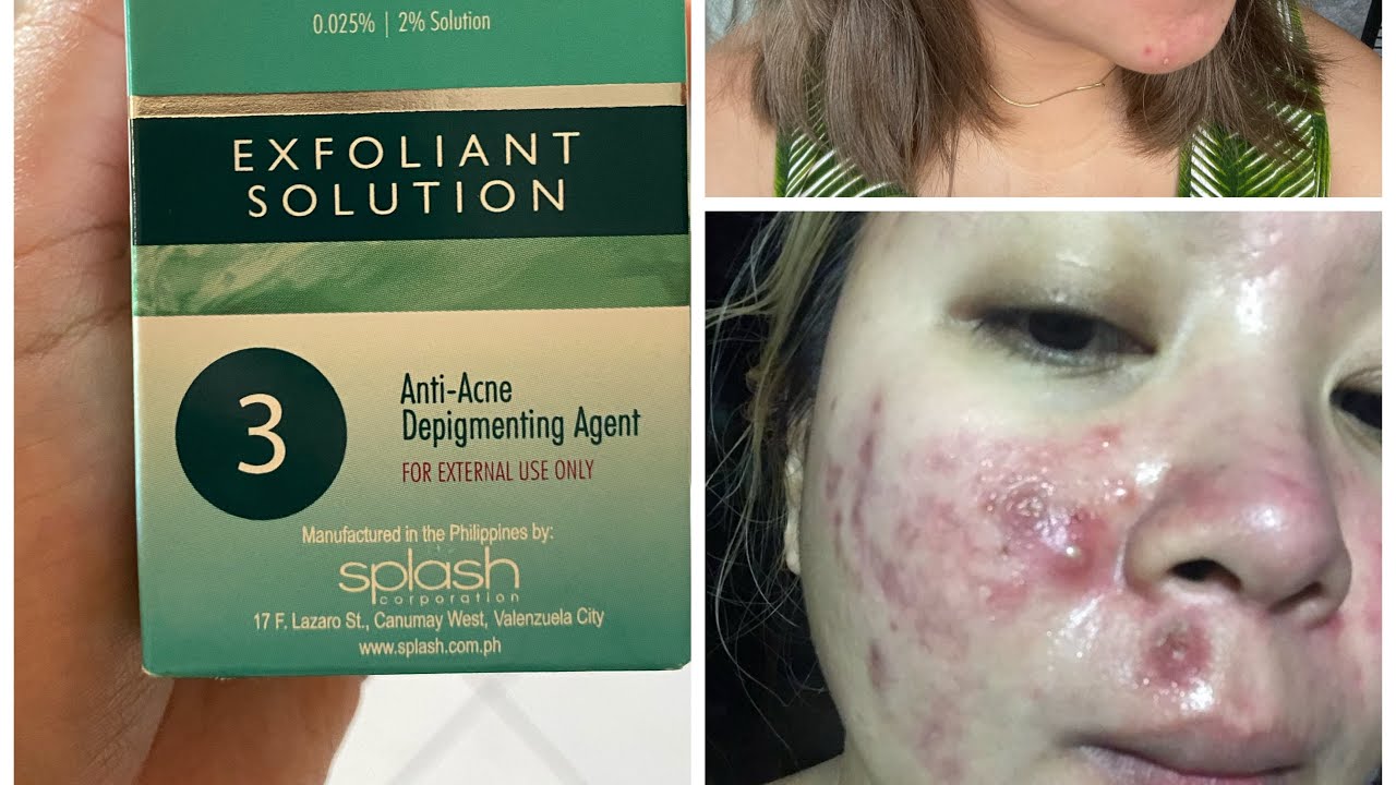 Acne Scars now fading! Maxipeel saved my Face!