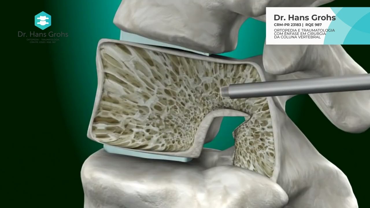 Dr. Hans Grohs - Cifoplastia