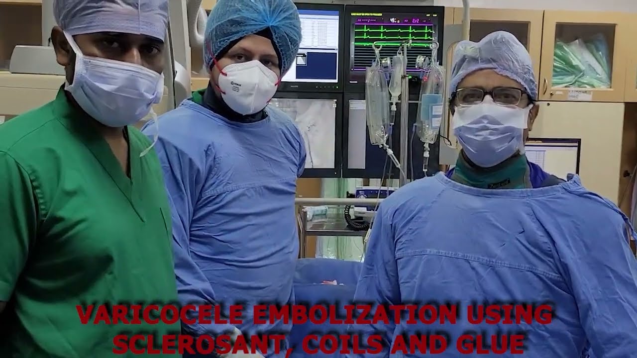 Varicocele embolization using sclerosant, coils and glue