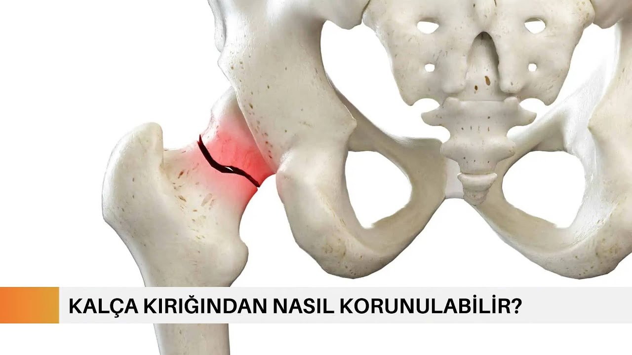 Kalça Kırığından Nasıl Korunulabilir? | Prof. Dr. Yakup YILDIRIM