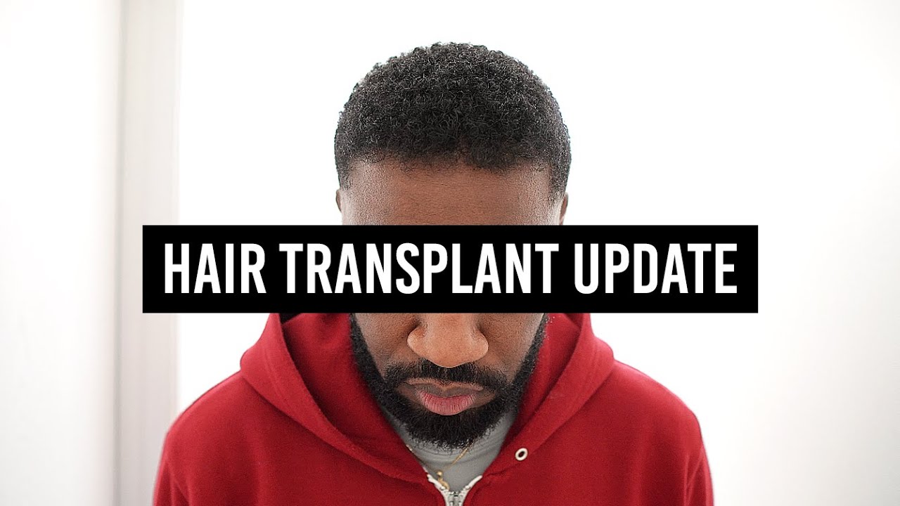 7 Month Istanbul, Turkey Hair Transplant Update | I AM RIO P.
