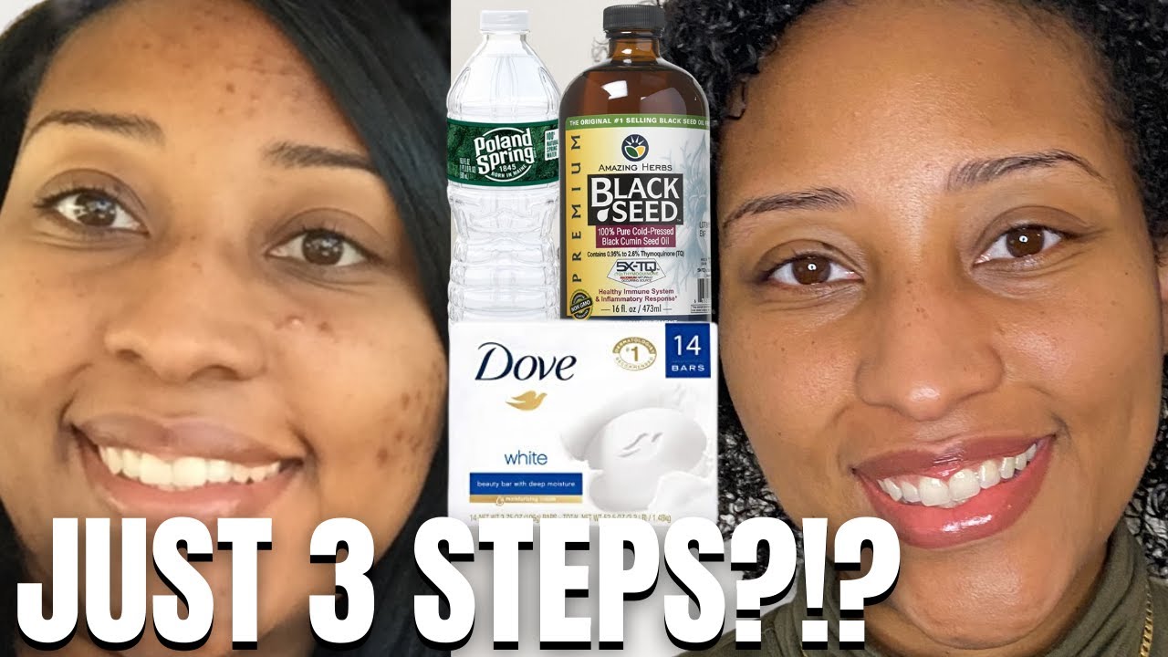 FADE Hyperpigmentation in Black Skin in 3 EASY Steps?!?!