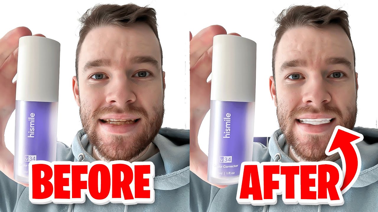 HiSmile v34 Colour Corrector | Get White Teeth Easy? | Honest Review