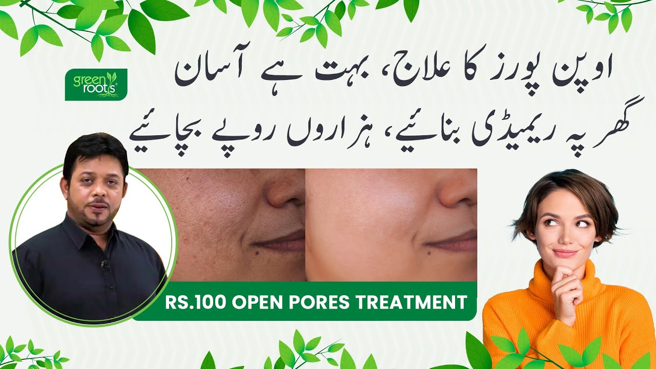 Open Pores Removal treatment at home by Dr Essa Herbalist | Green Roots