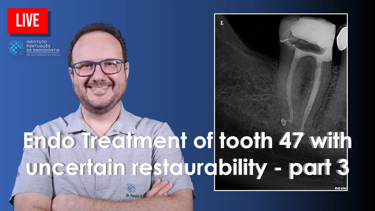 🔴  Endo Treatment of tooth 47 with uncertain restaurability - part  3