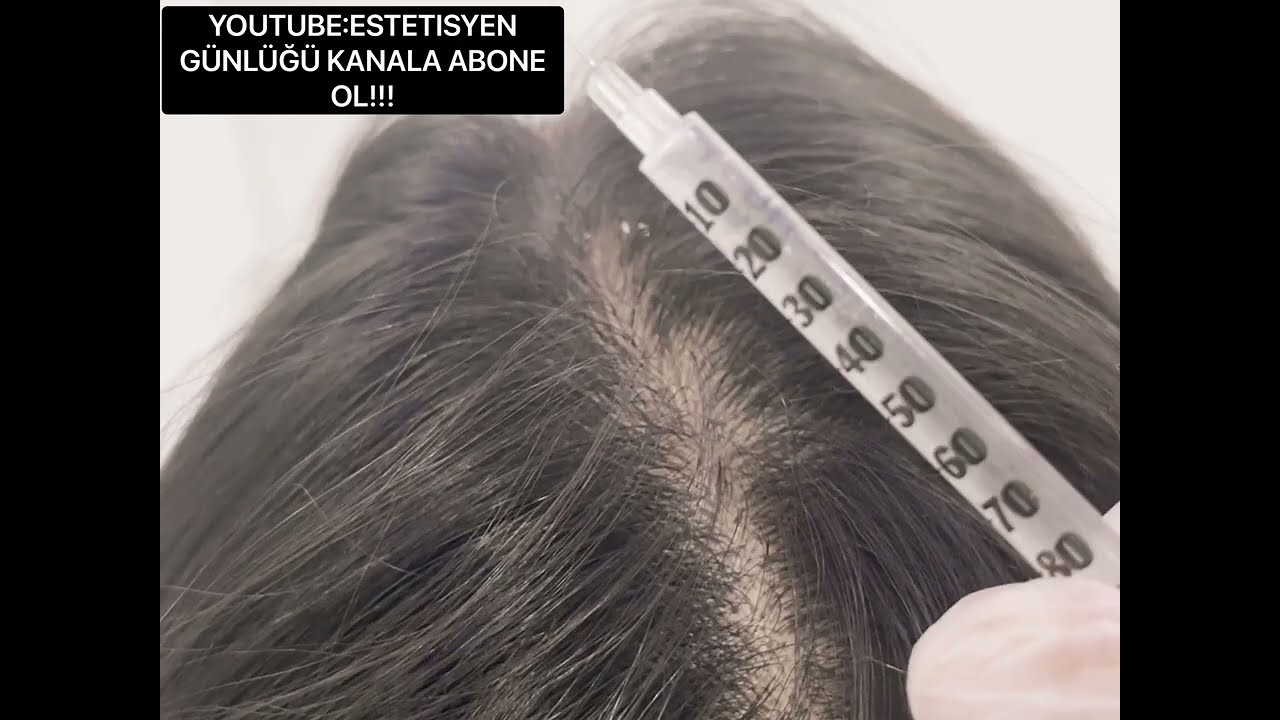 MEZO VANE 𝑯𝒂𝒊𝒓 SAÇ MEZOTERAPİ