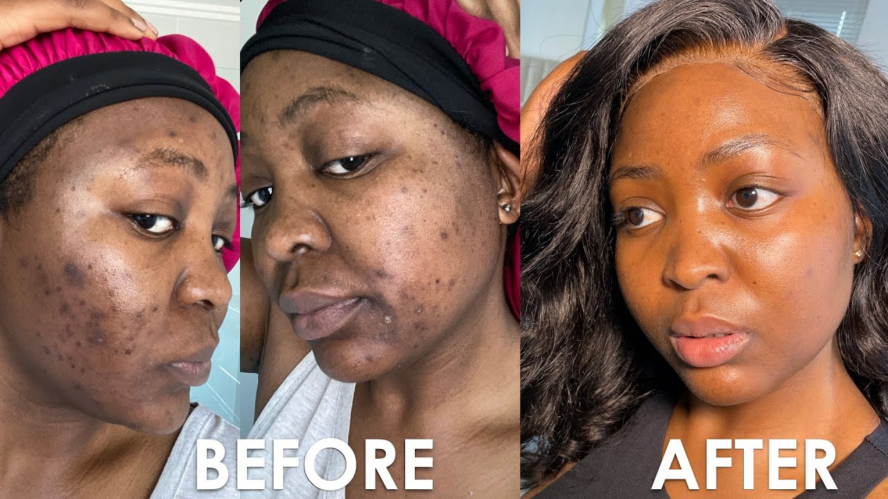 HOW I CLEARED MY ACNE | ACNE JOURNEY