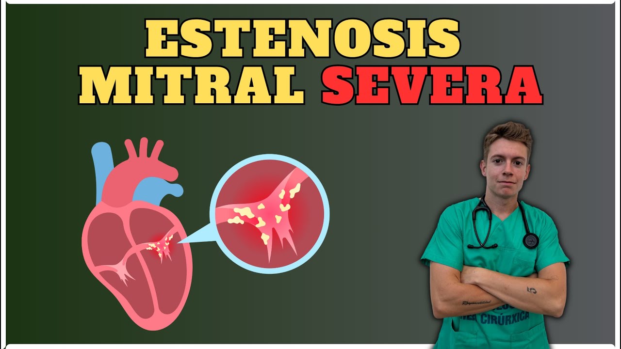 ¿Qué esconde la estenosis mitral severa?😱
