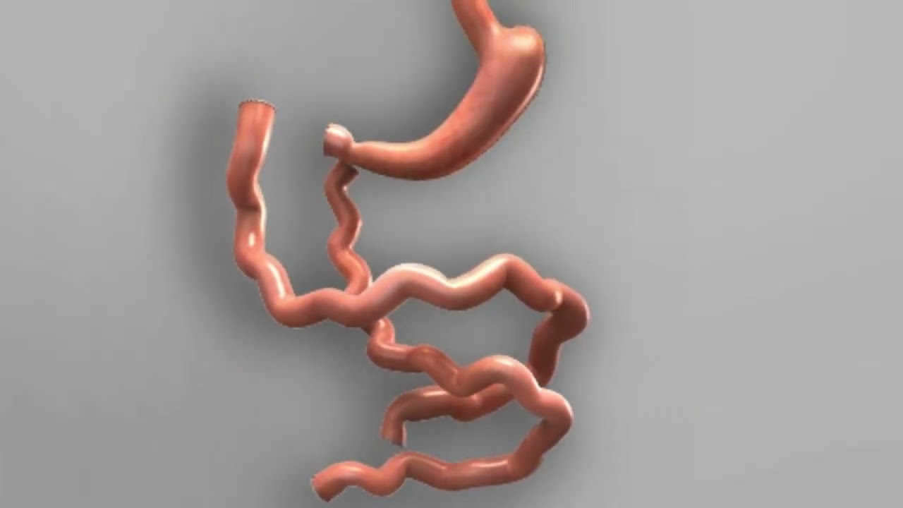 How Duodenal Switch Surgery is Performed