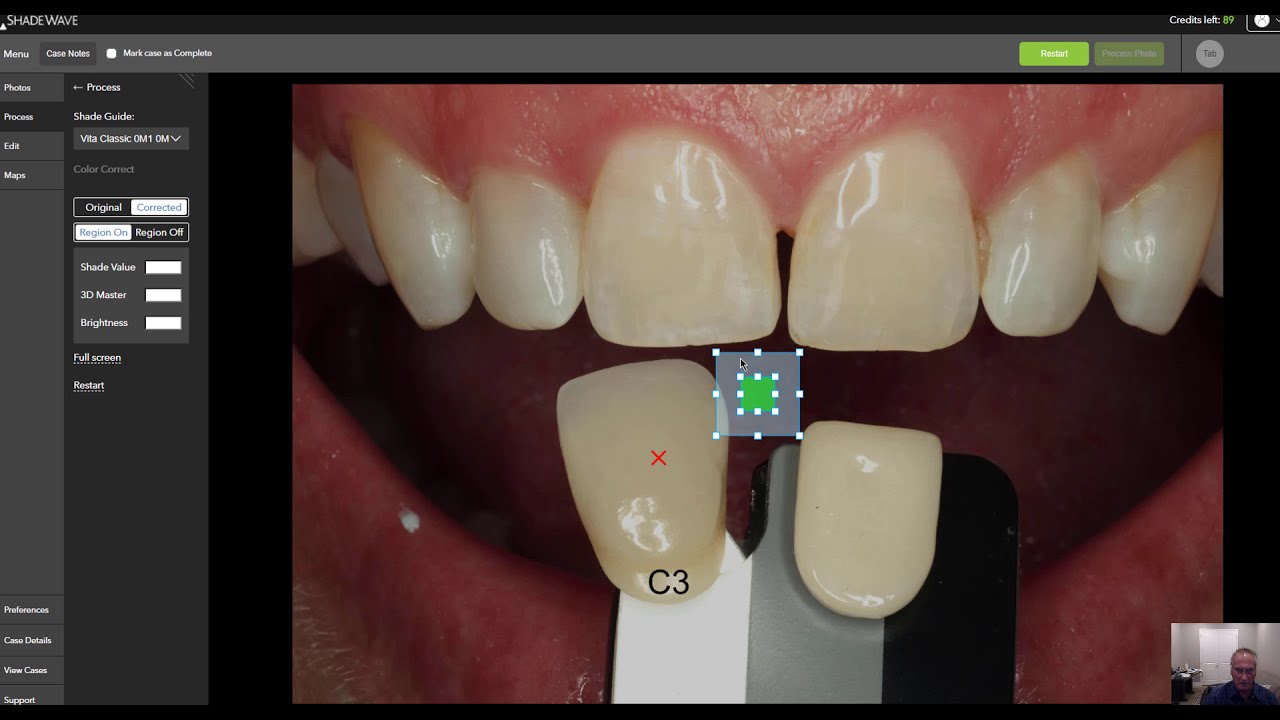 02 ShadeWave 2.0:  Process Case (short version) How to Get the Tooth Shade