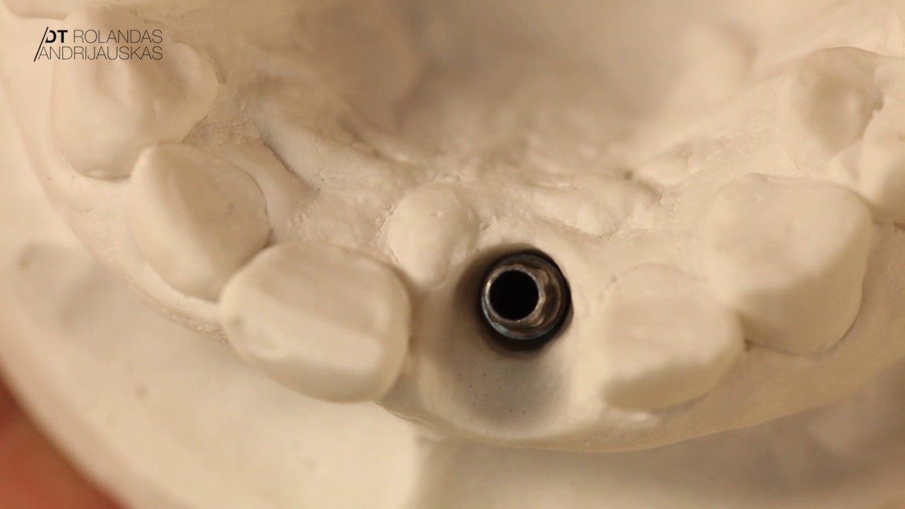 LAB part DT Rolandas Andrijauskas Zero bone loss concepts