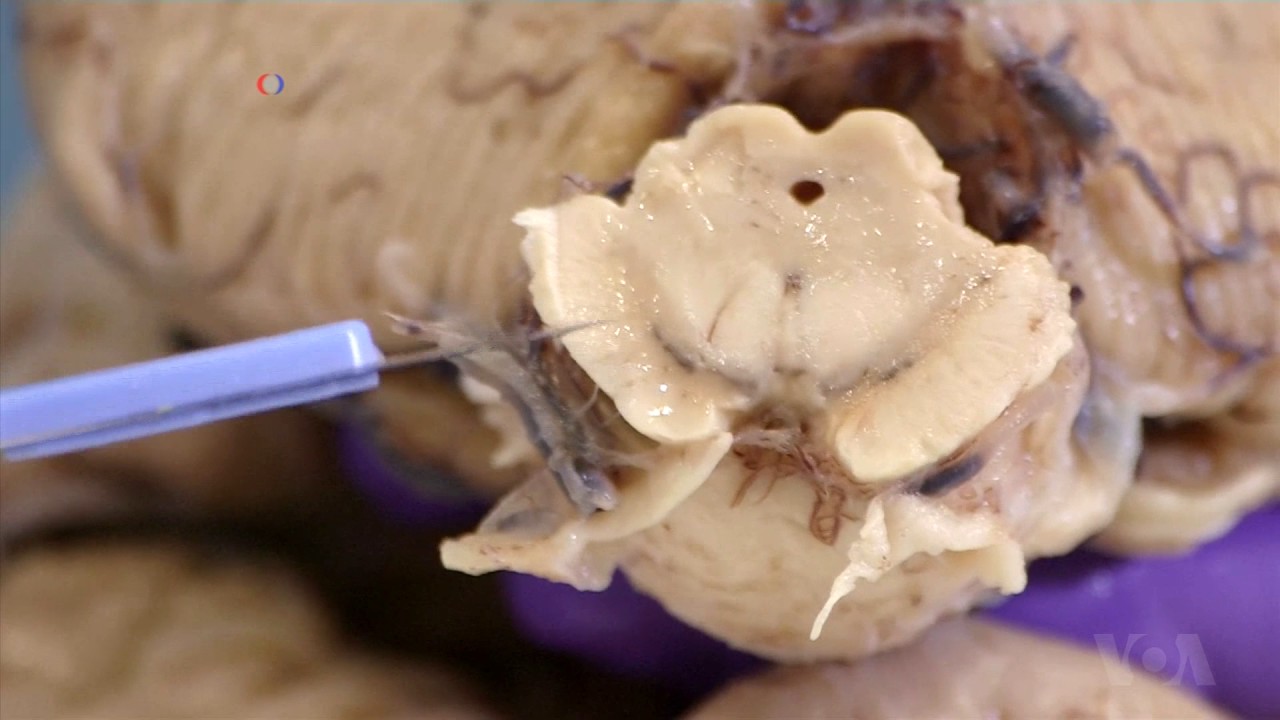 Scientists Research the Brain in an Effort to Stop Parkinson&rsquo;s Disease