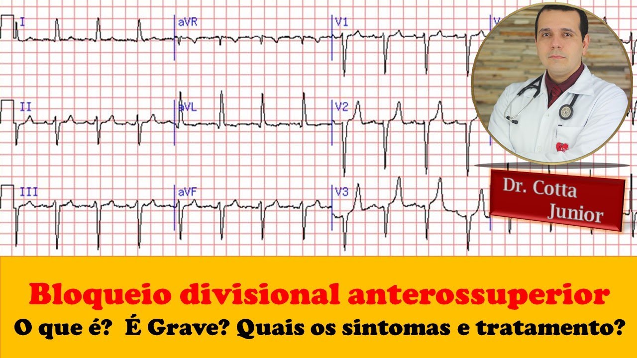 Bloqueio divisional anterossuperior? Entenda agora! O cardiologista responde
