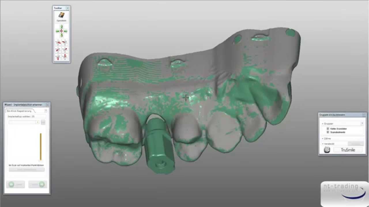 NT Dental - Hybrid Abutment Design in exocad®