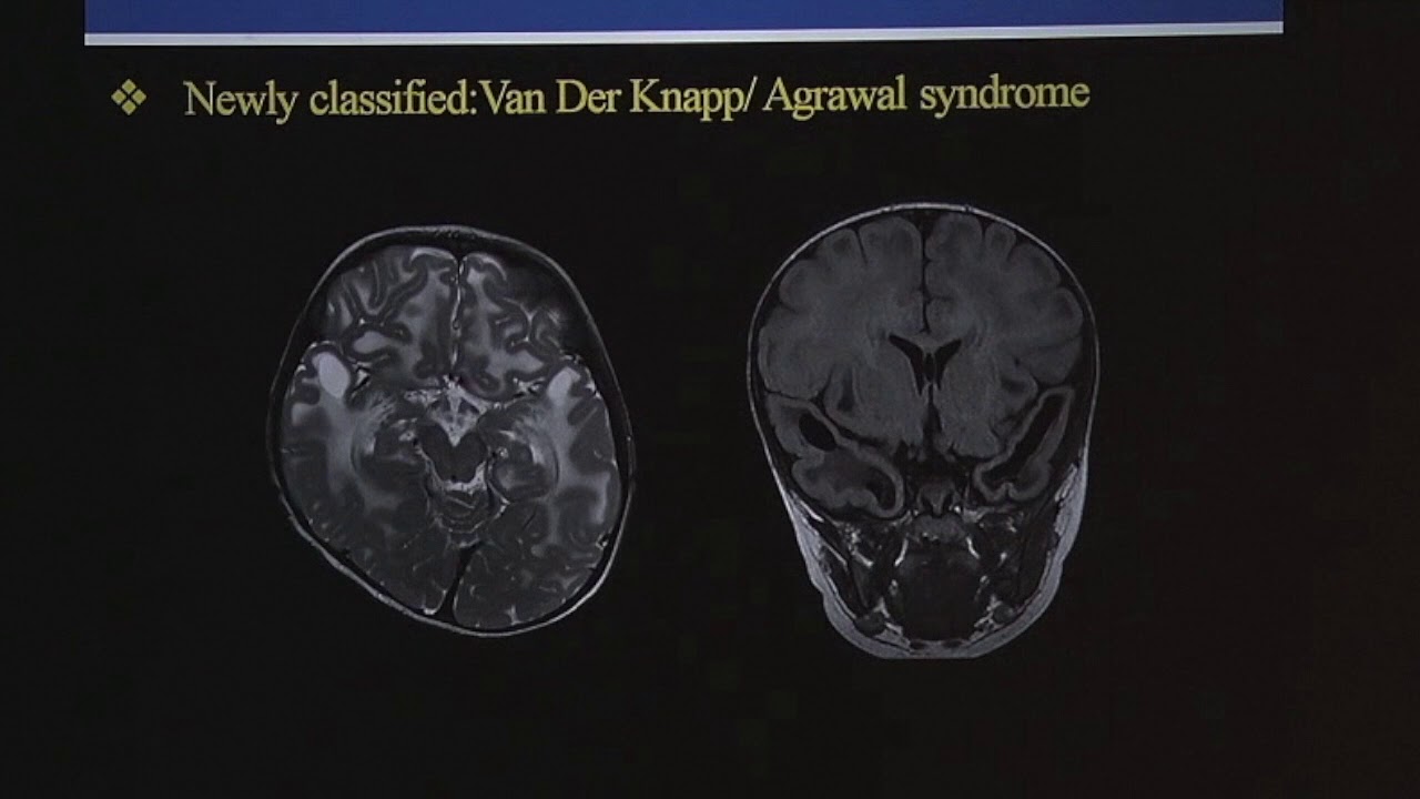 TMT: Pediatric White Matter Diseases by Dr Deepak Patkar- Part V