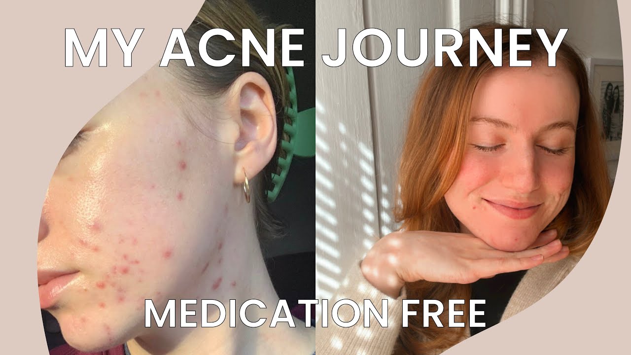 My Acne Journey - How I cleared my skin in 8 weeks | NO Spironolactone or Accutane