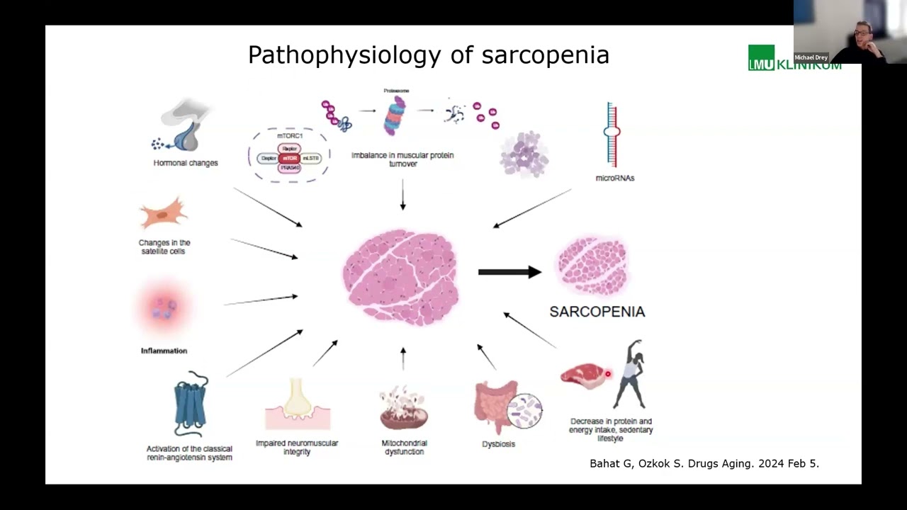 ESE Talks... Sarcopenia in Rare Endocrine Disorders - Webinar 1 Intro and speaker 1