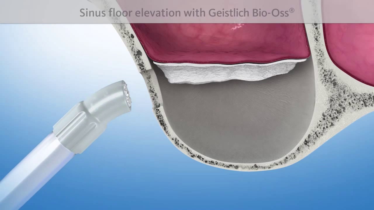External Sinus Lift