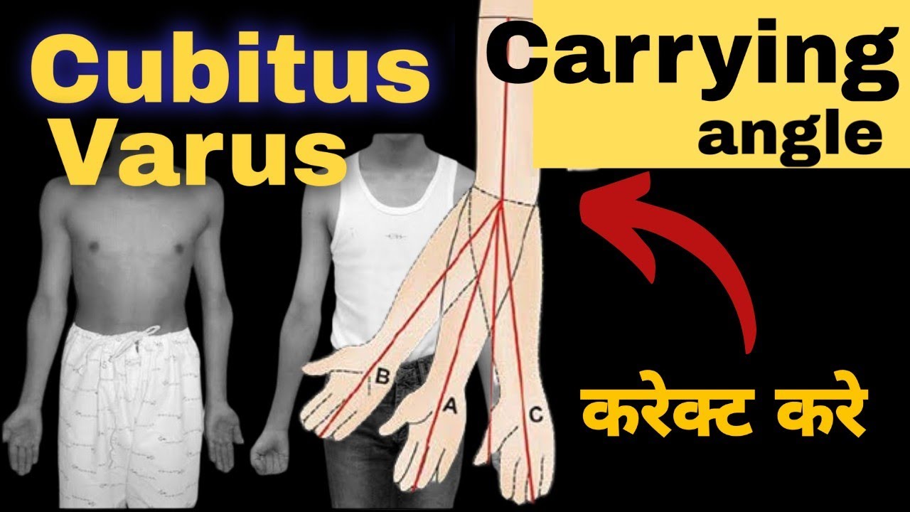 Exercise for Cubitus Varus In hindi. Cubitus Varus Treatment.Carrying angle treatment.#valgus #varus